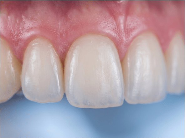 Root Canal Therapy
